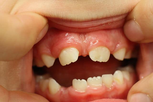 maxillary midline diastema