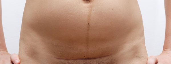 c-section scar at 6 weeks